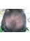 Pro Hair Transplant Clinic - Before 1000 FUE 