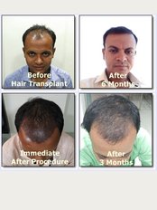 Dev Hair Transplant Clinic - 205, Palm Arcade Shukan Bunglow Cross Road, Ahmedabad, 382350, 