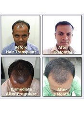 Dev Hair Transplant Clinic - 205, Palm Arcade Shukan Bunglow Cross Road, Ahmedabad, 382350,  0