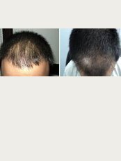Delhi Hair Clinic- Ambala - 200, Ist floor,, Model Town, Ambala City,, Haryana, 134003, 