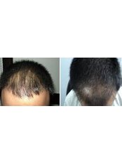 Delhi Hair Clinic- Ambala - 200, Ist floor,, Model Town, Ambala City,, Haryana, 134003,  0