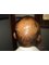 Dr. Rajguru Hair Care&Research Clinic - drrajguruhaircare&researchclinic-before treat 