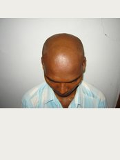 Dr. Rajguru Hair Care&Research Clinic - drrajguruhaircare&researchclinic-before treat