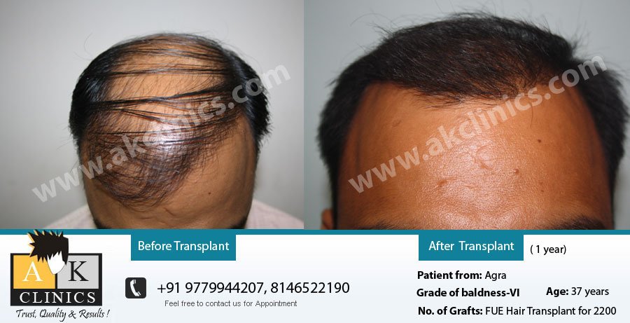 AK Clinics Pvt. Ltd Centre for Hair Transplant - Bangalore, India