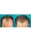 Delhi Hair Clinic- Bangalore - 146, 6TH- C ‘R’ Main Road, HMT Layout,, RT Nagar Post, Bangalore, Karnataka, 560032,  4