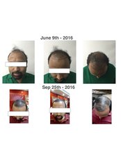 Hair Transplant - DHS Clinic