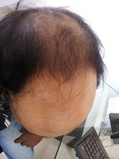 Before Hair Transplant - Revive Aesthetic Clinic- Bangalore