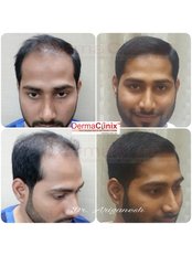 Hair Loss Specialist Consultation - Dermaclinix