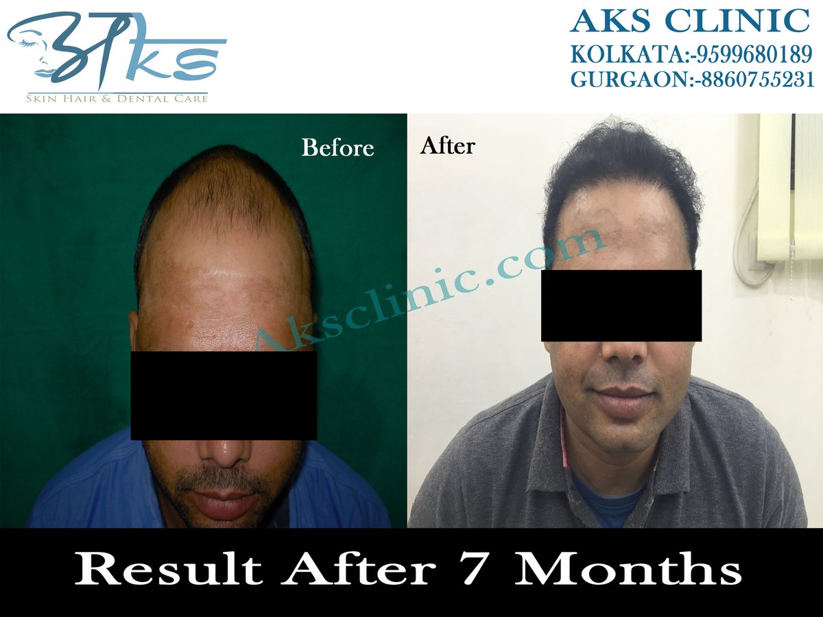 AKS Hair Transplant Clinic Hair Loss Clinic In Gurgaon