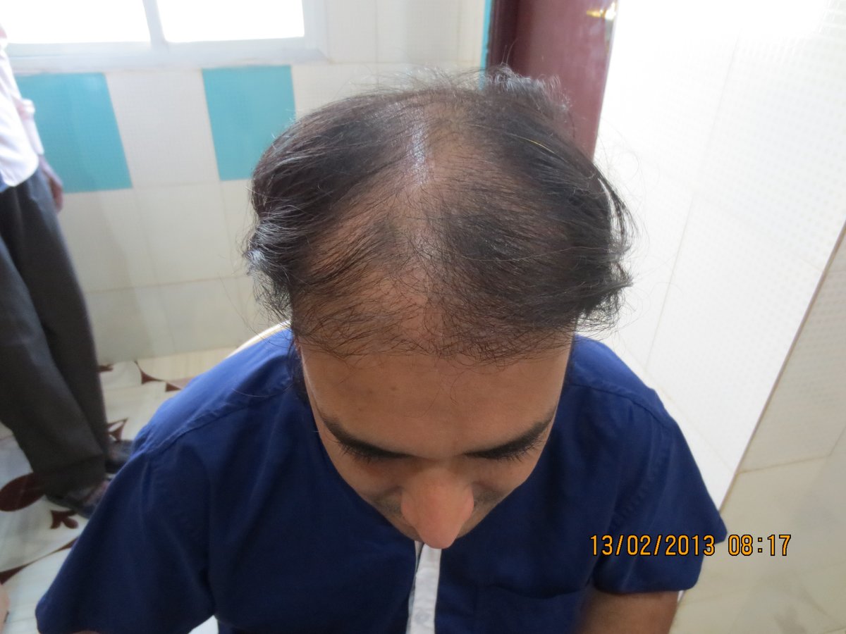 's exclusive hair transplant center - Banjara Hills in Hyderabad,  India