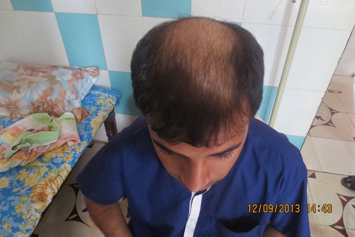 Dr.Khans exclusive hair transplant center