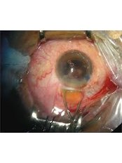 Cataract Treatment - NANOMEDIX Hospital