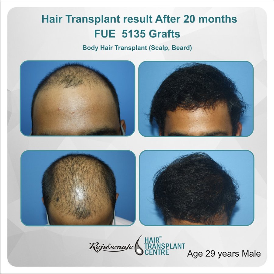 Rejuvenate Hair Transplant Centre in Indore, India • Read 2 Reviews