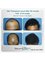 Rejuvenate Hair Transplant Centre - FUE Hair Transplant Result After 20 Months with 5135 Grafts 