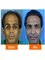 Asg Hair Transplant -Jalandhar - 422- A , COOL ROAD, MOTA SINGH NAGAR, FIRST FLOOR, JALANDHAR, Punjab, 141008,  1