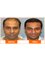 Asg Hair Transplant -Jalandhar - 422- A , COOL ROAD, MOTA SINGH NAGAR, FIRST FLOOR, JALANDHAR, Punjab, 141008,  25