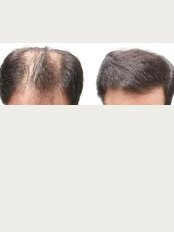 Delhi Hair Clinic - Jalandhar - 422 A Mota Singh Nagar, Cool Road, Jalandhar, punjab, 144001, 