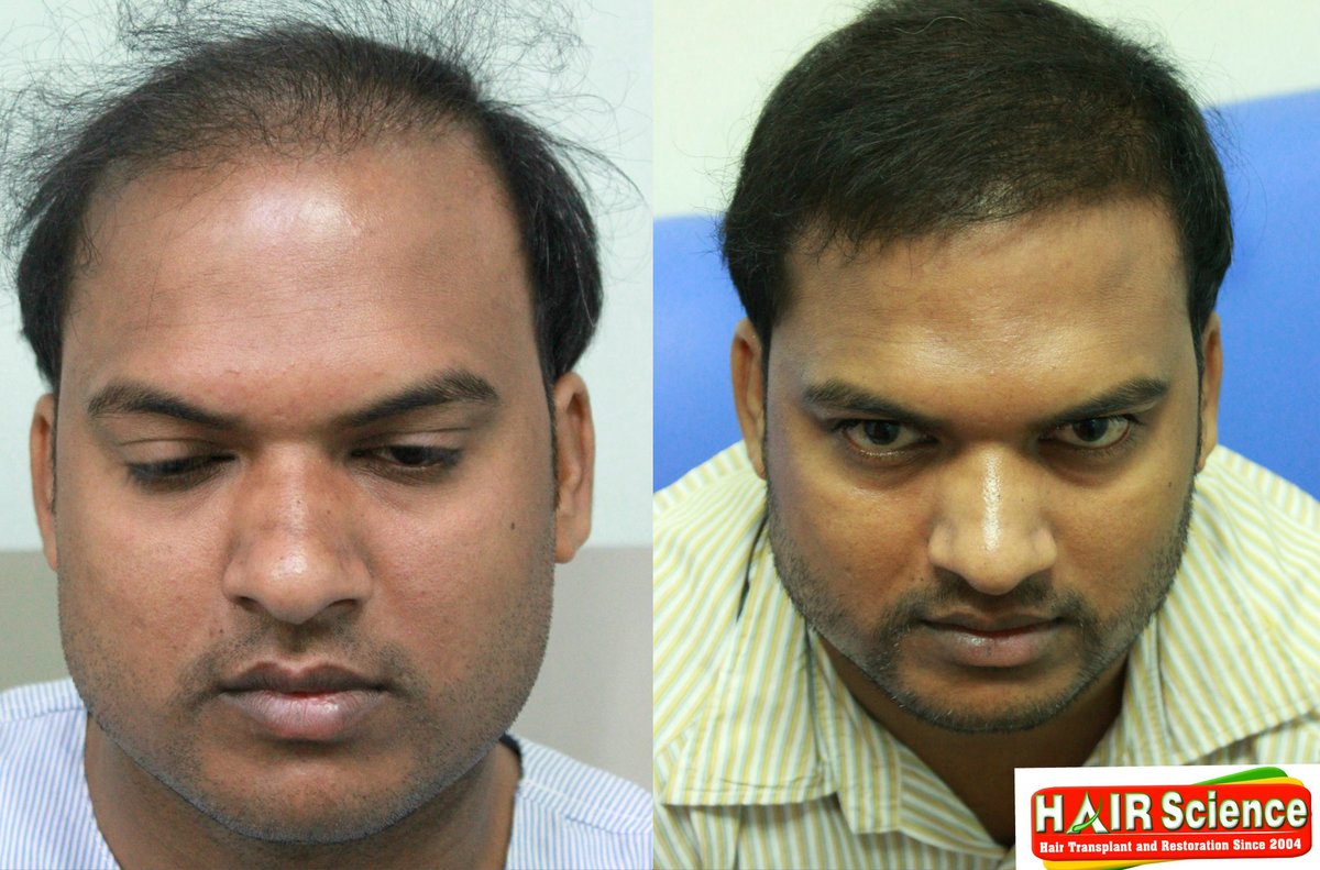 Hair Science Kolhapur Hair Loss Clinic In Kolhapur WhatCliniccom