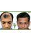 Anagen Hair Transplant Clinic- Mumbai - Bungalow No.86, Bollywood Lane, 4 Bunglow, Mhada Colony, Andheri west, Mumbai, Maharashtra, 400053,  4