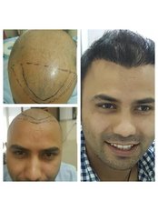 Hair Transplant - Assure Clinic