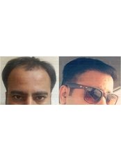 Sapphire Hair Transplant - Prime Hair Studio - Mumbai