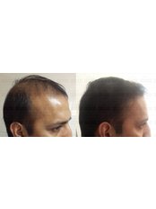 Biofibre Hair Implant - Prime Hair Studio - Mumbai