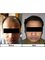 Prime Hair Studio - Mumbai - Hair Transplant using FUE method (4000 grafts) 