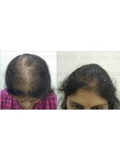 Biofibre Hair Implant - RenéePrime Aesthetic Clinic, Mumbai