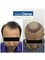 MaxDense Hair Clinic - fue hair transplant 