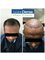 MaxDense Hair Clinic - best hair transplant 