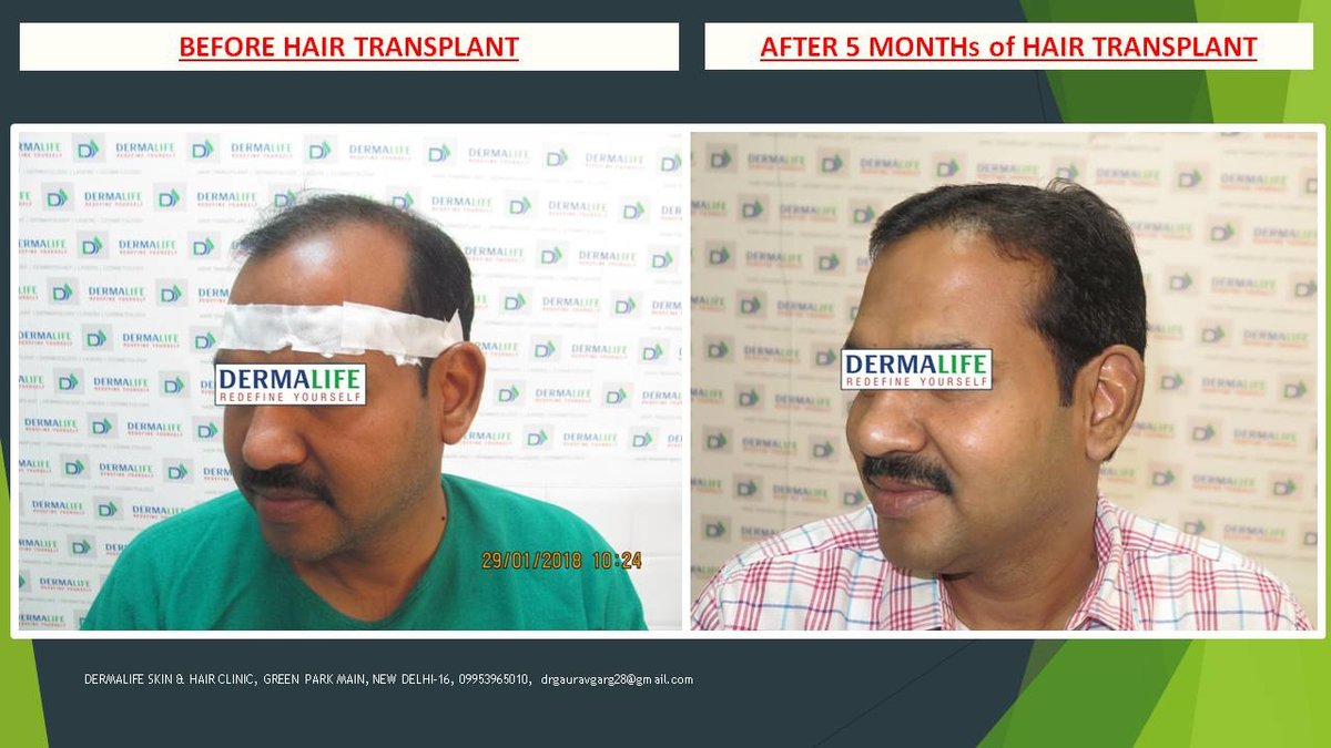 Dermalife Skin and Hair Clinic in New Delhi, India