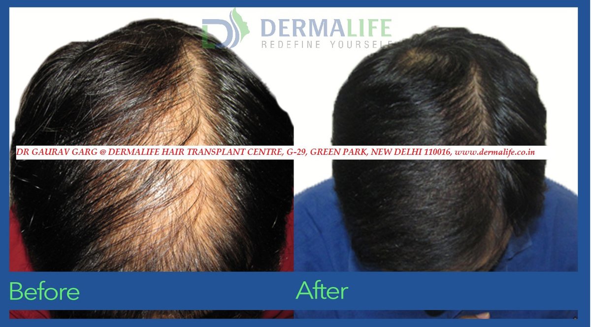 Dermalife Skin and Hair Clinic in New Delhi, India