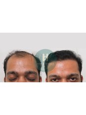 Hair Loss Specialist Consultation - Hair and Senses