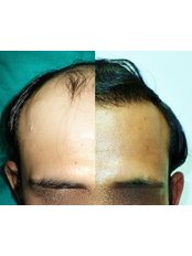 Hair Transplant - Provelus Hair Transplant Clinic