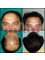 Provelus Hair Transplant Clinic - 1001, Padma Tower-1, Rajendra Place, Pusa Road, New Delhi, Delhi, 110008,  10