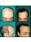 Provelus Hair Transplant Clinic - 1001, Padma Tower-1, Rajendra Place, Pusa Road, New Delhi, Delhi, 110008,  8