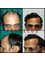 Provelus Hair Transplant Clinic - 1001, Padma Tower-1, Rajendra Place, Pusa Road, New Delhi, Delhi, 110008,  6