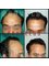 Provelus Hair Transplant Clinic - 1001, Padma Tower-1, Rajendra Place, Pusa Road, New Delhi, Delhi, 110008,  3