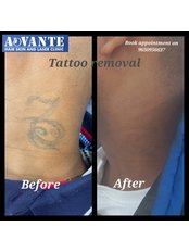 Laser Tattoo removal - Advante Hair Skin and Laser Clinic