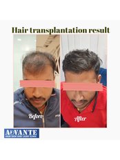 Hair transplant result - Advante Hair Skin and Laser Clinic