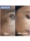 Advante Hair Skin and Laser Clinic - pigmentation treatment 