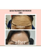 Treatment for Wrinkles - Advante Hair Skin and Laser Clinic