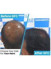 Hair Transplant - I Graft - Pune