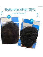 Hair Loss Treatment - I Graft - Pune