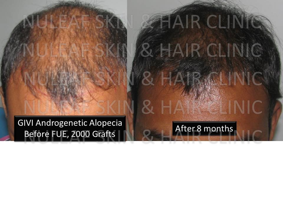Nuleaf Skin Hair Clinic in Pune, India