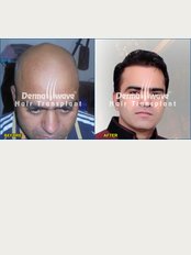 Dermawave Hair Transplant and Dermacare Skin & Laser Cdentre - 301,Pranami Heights, Circular Road Above Westside,Beside K C Roy Memorial Hospital, Lalpur Chowk, New Barhi Toli, Ranchi, Jharkhand, 834001, 