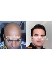 Dermawave Hair Transplant and Dermacare Skin & Laser Cdentre - 301,Pranami Heights, Circular Road Above Westside,Beside K C Roy Memorial Hospital, Lalpur Chowk, New Barhi Toli, Ranchi, Jharkhand, 834001,  0