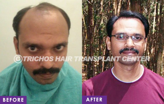TRICHOS Hair Transplant Institute in Secunderabad, India • Read 16 Reviews