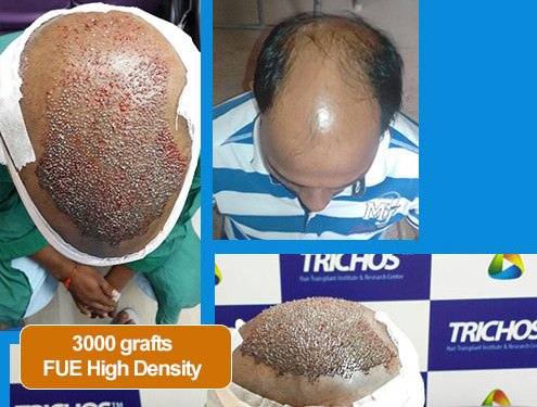 TRICHOS Hair Transplant Institute in Secunderabad, India • Read 16 Reviews