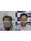 TRICHOS Hair Transplant Institute - Plot no 72,1st Floor,, Above Vision Express, Opp AS Rao nagar Khaman, Hyderabad, Hyderabad, Telangana, 500062,  10